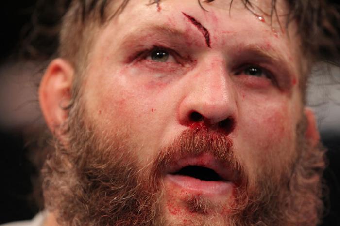 LAS VEGAS, NV - FEBRUARY 04: Roy Nelson displays his cut from his fight with Fabricio Werdum during the UFC 143 event at Mandalay Bay Events Center on February 4, 2012 in Las Vegas, Nevada. (Photo by Nick Laham/Zuffa LLC/Zuffa LLC via Getty Images) ***