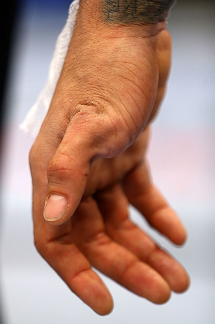 NEWARK, NJ - APRIL 27: The injured hand of Yancy Medeiros is seen after his lightweight bout against Rustam Khabilov of Russia during the UFC 159 event at the Prudential Center on April 27, 2013 in Newark, New Jersey. (Photo by Al Bello/Zuffa LLC/Zuffa