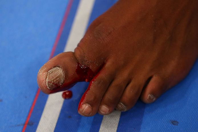 NEWARK, NJ - APRIL 27: The broken toe of Jon Jones is seen after Jones won the light heavyweight championship bout against Chael Sonnen during the UFC 159 event at the Prudential Center on April 27, 2013 in Newark, New Jersey. (Photo by Al Bello/Zuffa LL